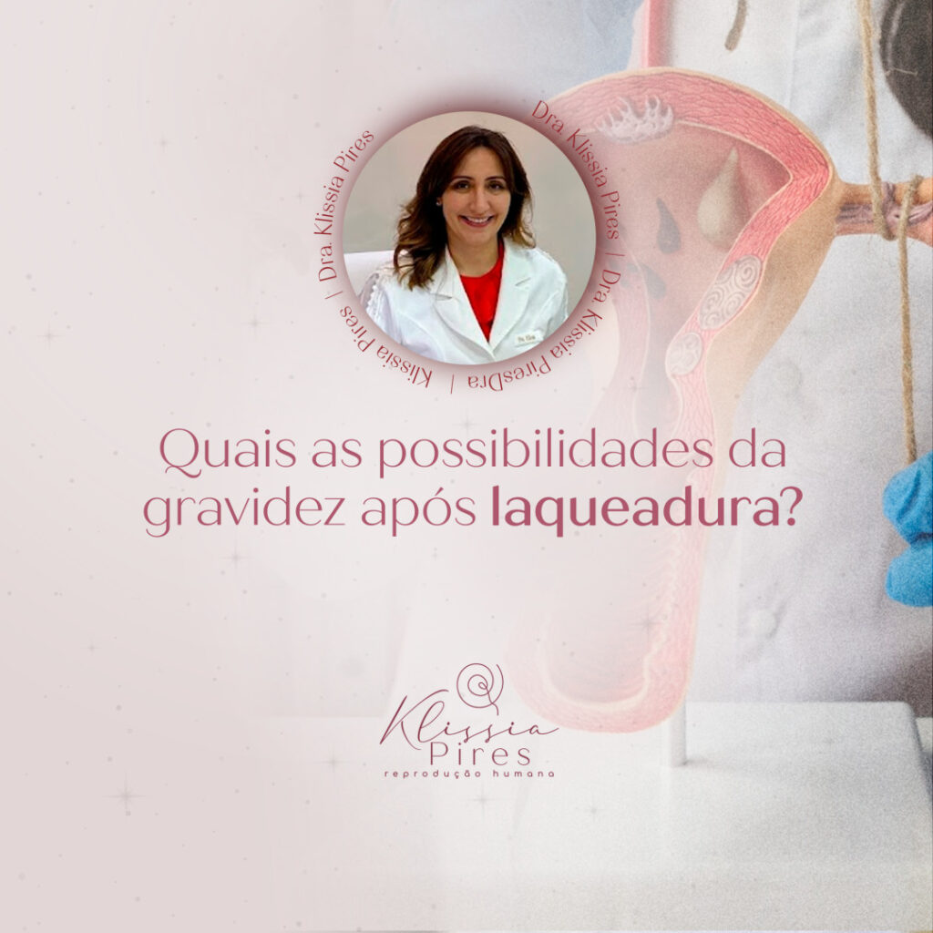 quais-possibilidades-da-gravidez-apos-laqueadura-dra-klissia-pires-medica-fertilidade-campo-grande-ms