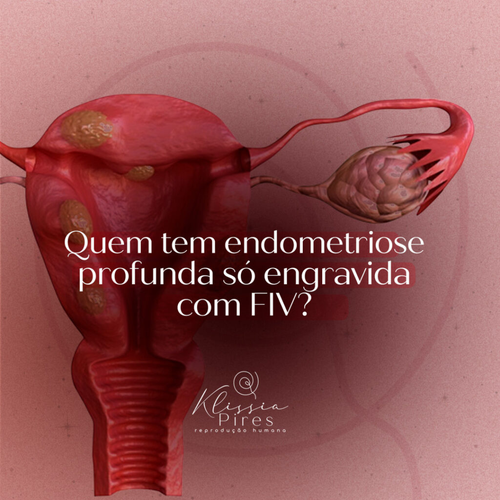 quem-tem-endometriose-profunda-engravida-com-fiv-dra-klissia-pires-medica-fertilidade-campo-grande-ms